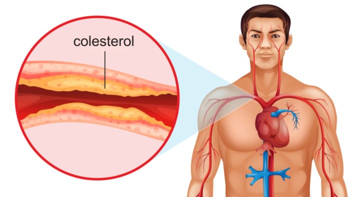 Apa itu Kolesterol 1