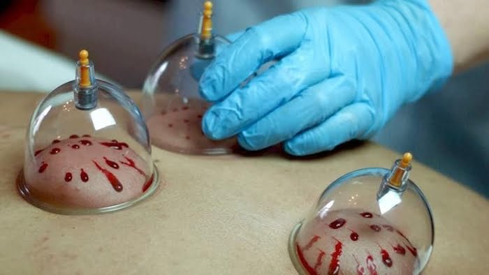 Sekilas Tentang Bekam 1