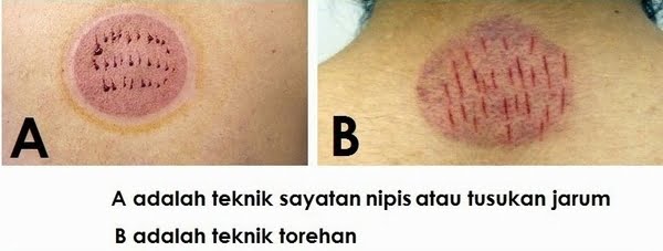 Bekam dengan Pisau atau Jarum? 2