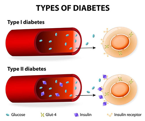 Penyakit Diabetes Mellitus 1