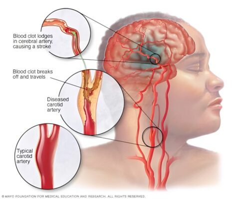 Kesan Terapi Bekam Kepada Kekakuan (spasticity) Anggota Tubuh Atas Selepas Strok 1