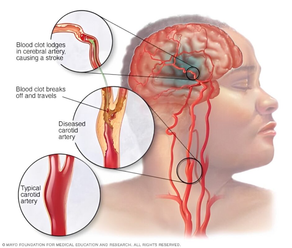 Kesan Terapi Bekam Kepada Kekakuan (spasticity) Anggota Tubuh Atas Selepas Strok 1