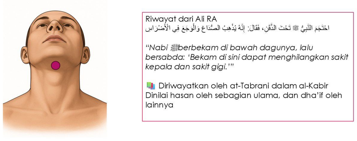 Bekam Tahta adz-Dzuqnu: Keberkesanan, Titik Akupunktur & Manfaat Menurut Sunnah 1