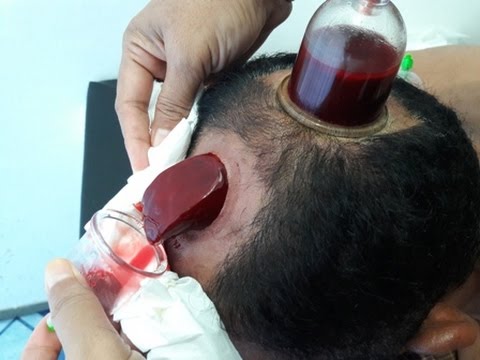 Bekam Kepala: Terapi Tradisional yang Menarik Minat Dunia Moden 3