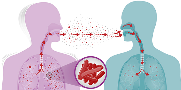 Tuberkulosis (Tibi): Perjuangan Menentang Bakteria Purba di Zaman Moden 1