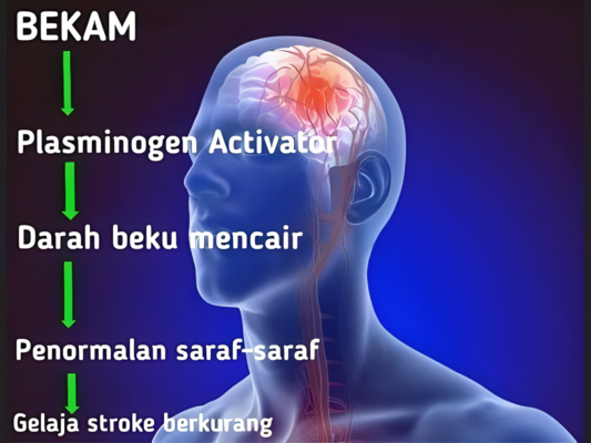 Bagaimana Bekam Boleh Cegah Strok: Mekanisme, Bukti Saintifik, dan Aplikasi Klinikal 2